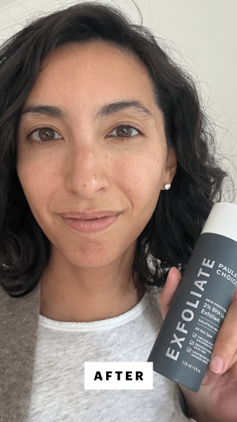 Pai after applying the Paulas Choice Skin Perfecting 2 BHA Liquid Exfoliant